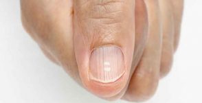 Ridged nails: what care for ridged nails?
