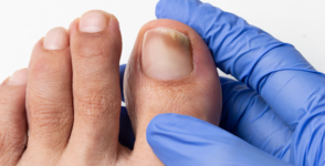 Do you know about nail fungus?