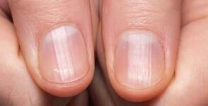 Nails split lengthwise: Causes and symptoms
